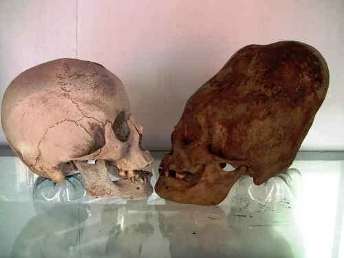 Comparison of an ordinary human skull with a "Paracas" skull.